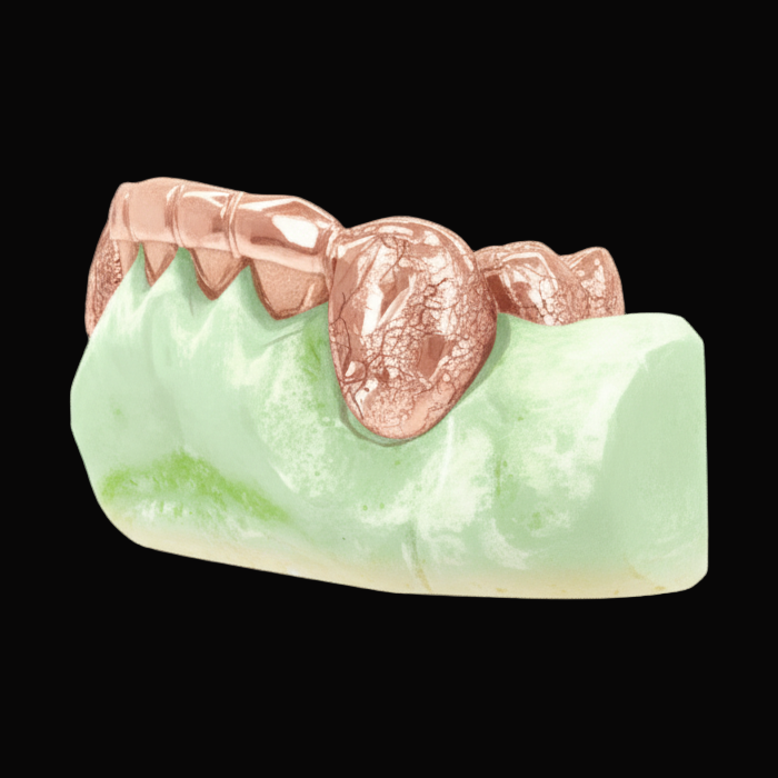 Custom 2 Teeth With Front Bar With Nugget Cut On Fangs Gold Grillz
