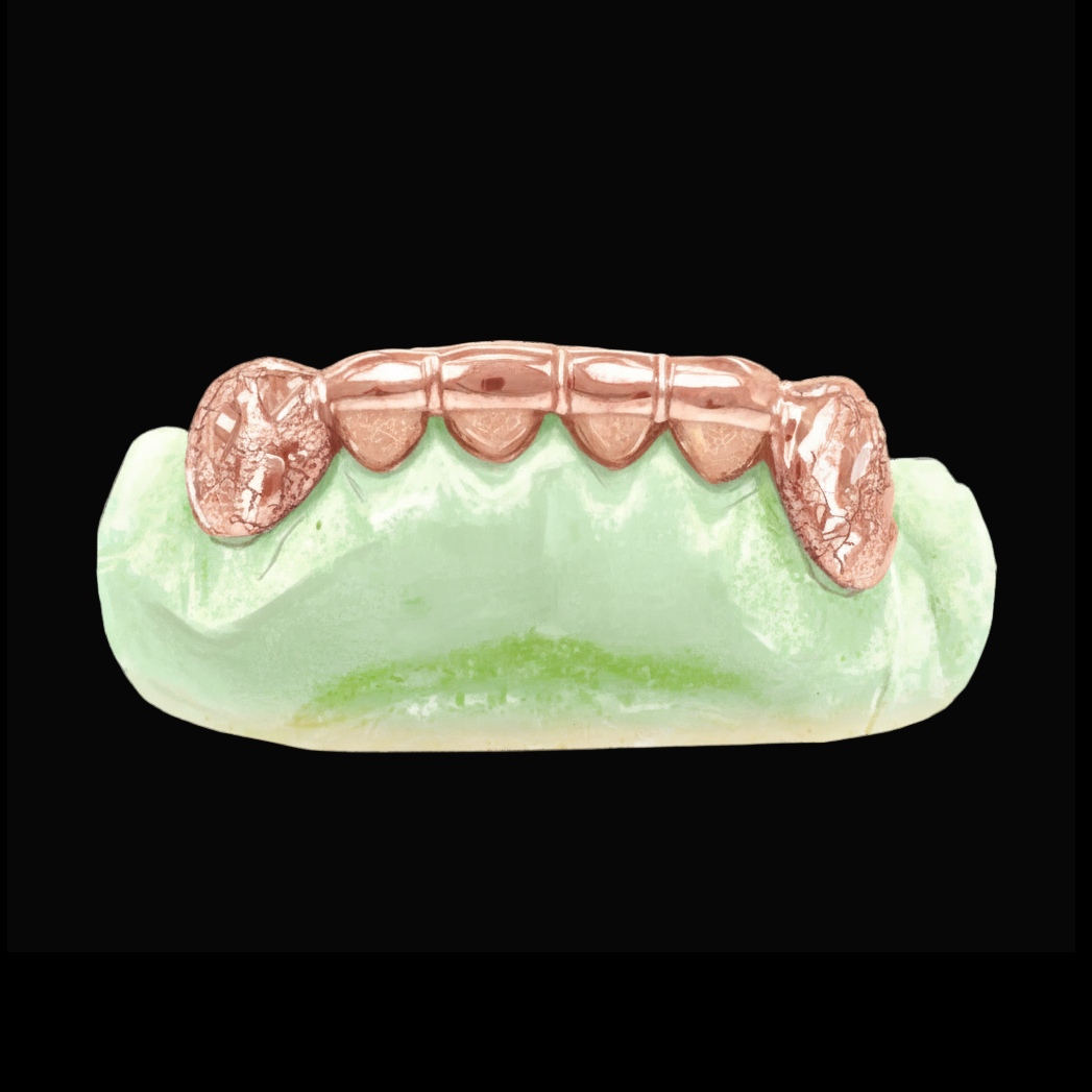 Custom 2 Teeth With Front Bar With Nugget Cut On Fangs Gold Grillz
