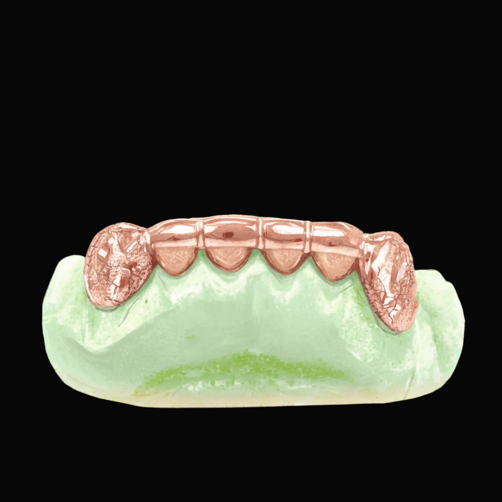 Custom 2 Teeth With Front Bar With Nugget Cut On Fangs Gold Grillz