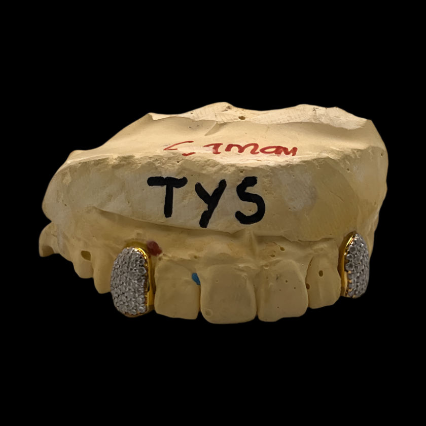 Gold VVS Moissanite 2 Teeth Grillz on Lateral Incisors with Micro-Pavé Setting